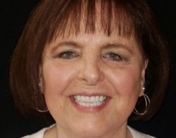 Anterior Crowns | KoR Whitening