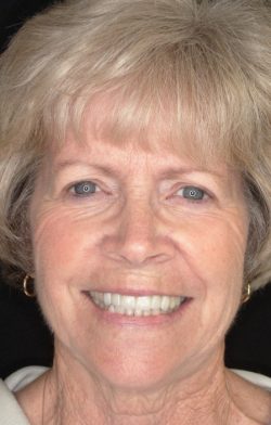 Anterior Crowns | KoR Whitening