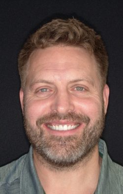 Anterior Crowns 8 and 9 | Veneers 7 and 10 | KoR Whitening