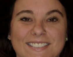 Veneers | KoR Whitening