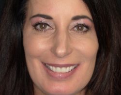 Anterior Crowns | Re-contouring