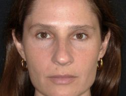 Total Skin | Facial Balancing| Filler and Tox