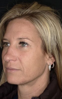 Total Skin | Neurotoxin