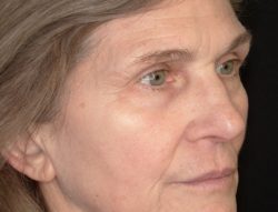 Total Skin | Perioral Filler | ZO Skin Health