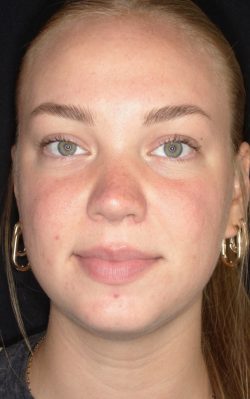 Ultra Resurfacing | ZO Skin Health